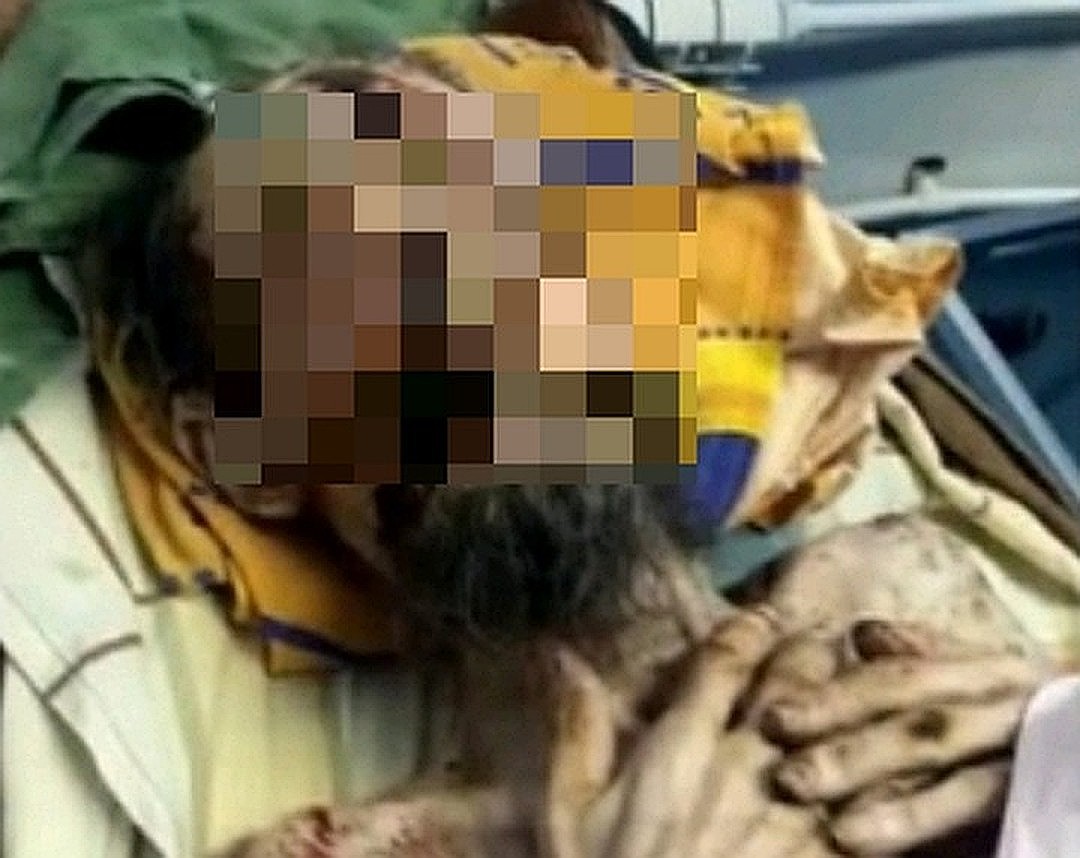«Живая мумия» из медвежьей берлоги – больной псориазом казахстанец